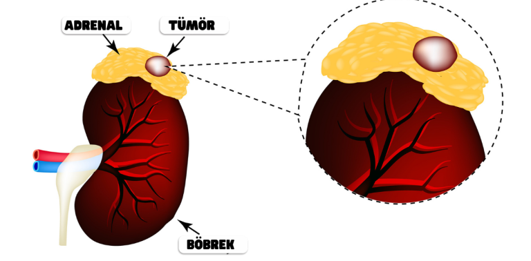 Adrenal (böbrek üstü bezi) tümörü anatomik illüstrasyon