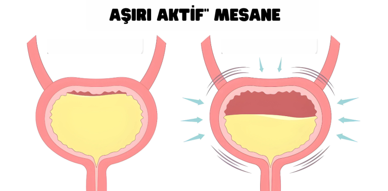 Aşırı aktif mesane anatomik illüstrasyon