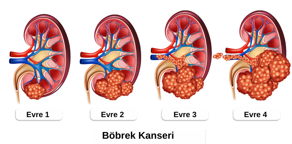 Böbrek kanseri evreleri (Evre 1-4)