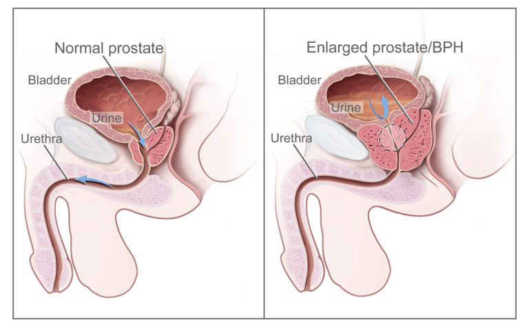 Normal prostat ve büyümüş prostat (BPH) karşılaştırması