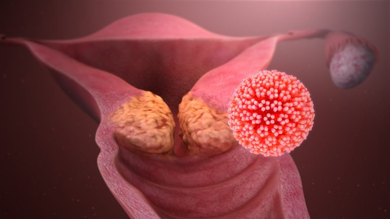 HPV ve Genital Siğil