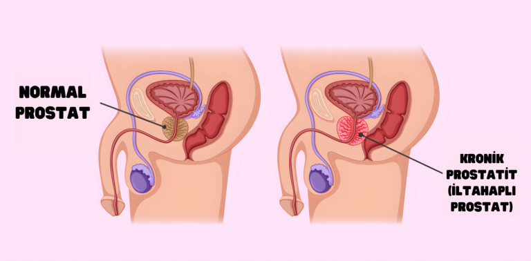 Normal prostat ve kronik prostatit (iltihaplı prostat) karşılaştırması