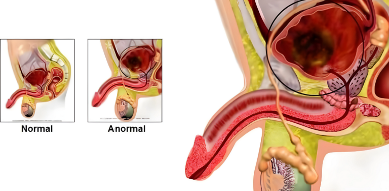 Mesane Kanseri - Normal ve Anormal Karşılaştırma