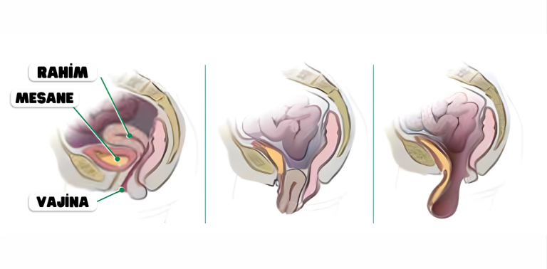 Mesane ve rahim sarkması (sistosel) anatomik illüstrasyon