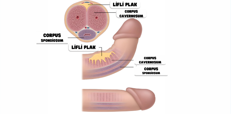 Doğuştan penis eğriliği anatomik illüstrasyon