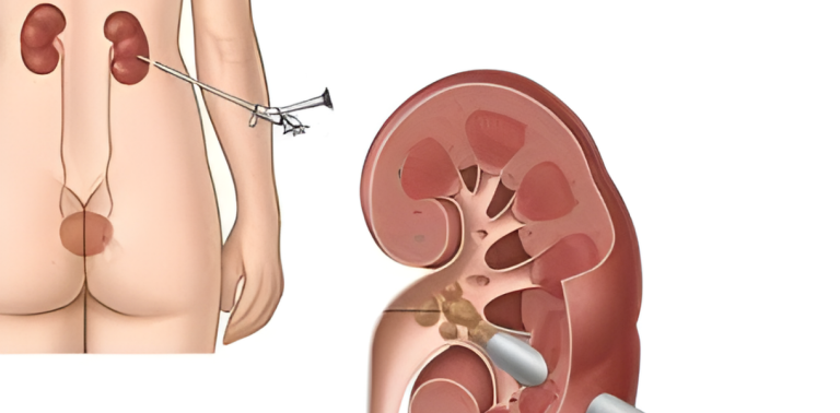 Perkütan nefrolitotomi (PNL) anatomik illüstrasyon