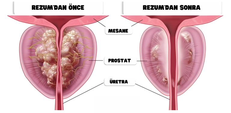 REZUM tedavisi öncesi ve sonrası — büyümüş ve küçülmüş prostat karşılaştırması