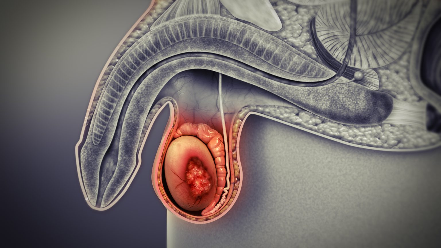 Testis kanseri anatomik illüstrasyon
