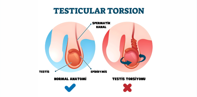 Testis Torsiyonu