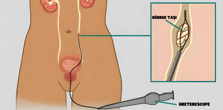 Üreterorenoskopi (URS) anatomik illüstrasyon