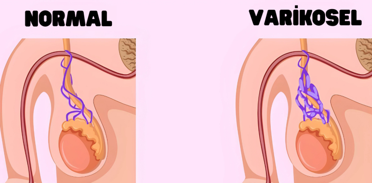 Normal testis ve varikosel karşılaştırması